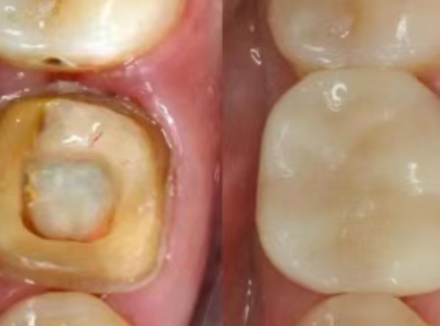 根管治療（抽神經(jīng)）后，為什么一定要做牙冠？